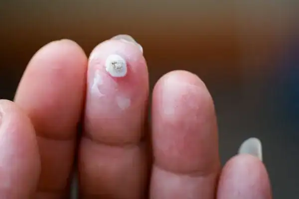 Image of white wart before cryopen treatment Edgware