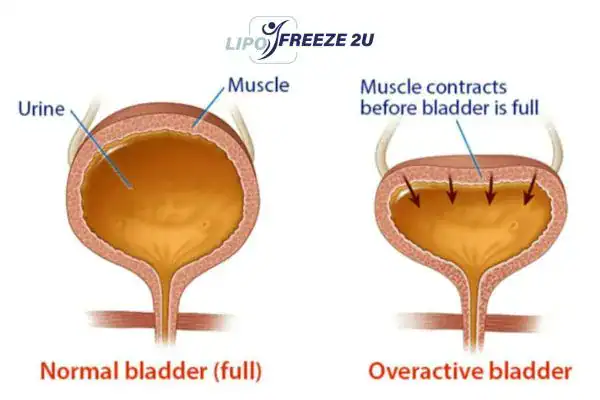 diagram of overactive bladder treatment Edgware