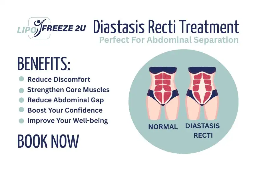 Benefits of body toning treatment Edgware for Diastasis recti