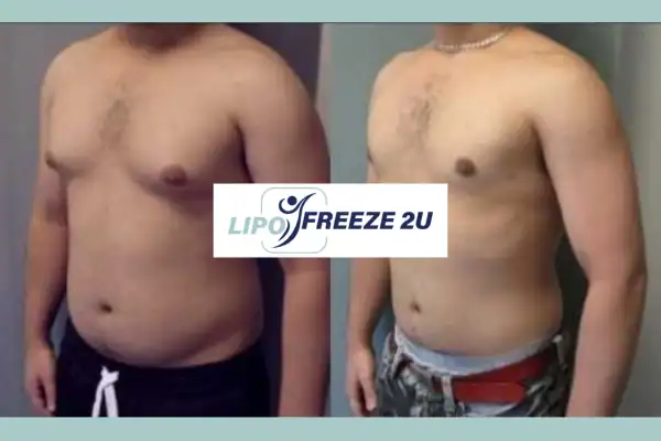 How Long Does It Take to See Results Edgware?