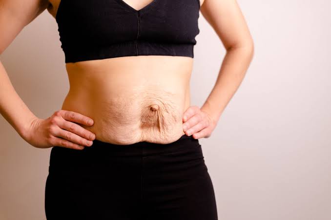 Is Surgery Really the Only Way to Repair Diastasis Recti Edgware?