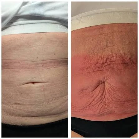 How Does RF Microneedling Improve Crepey, Thin and Uneven Skin Texture Edgware?
