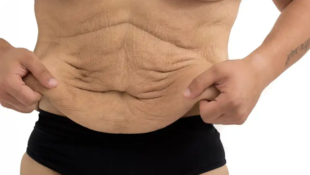 RF Microneedling for Loose Skin: How Can It Help Tighten and Reshape the Skin Edgware?
